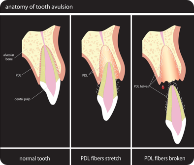 New Rochelle Root Canal - Cracked Teeth